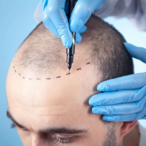 Hair Transplant course 3/4/2026